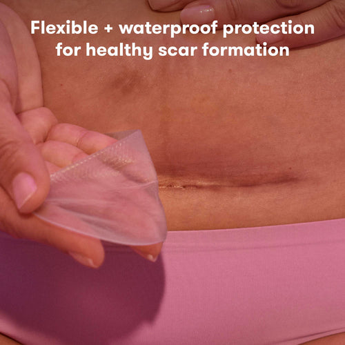 OVELLA — Silicon Scar Patches